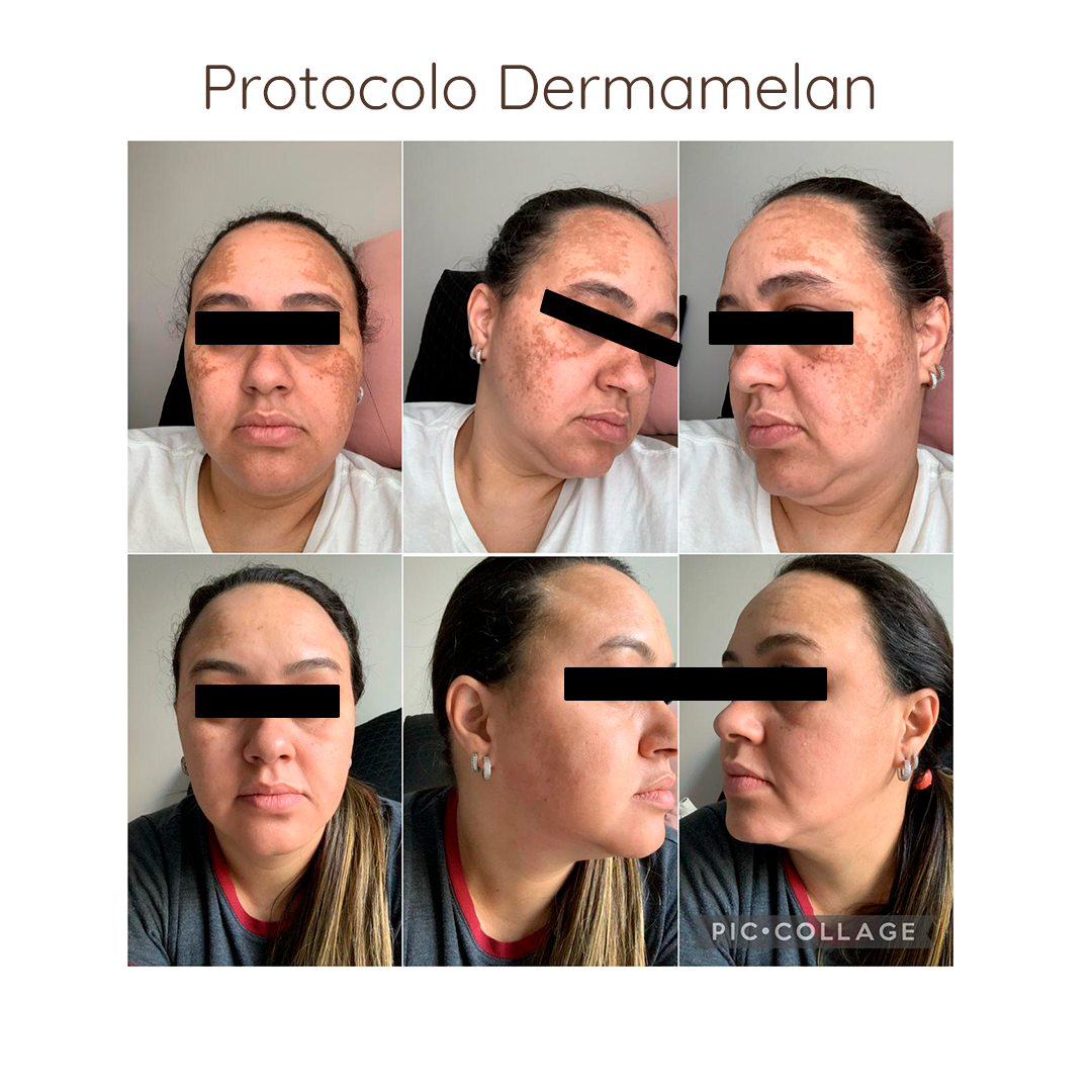 Dermamelan Home Pack